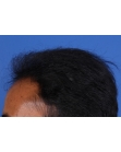 Before Hair Transplant&nbsp;Front